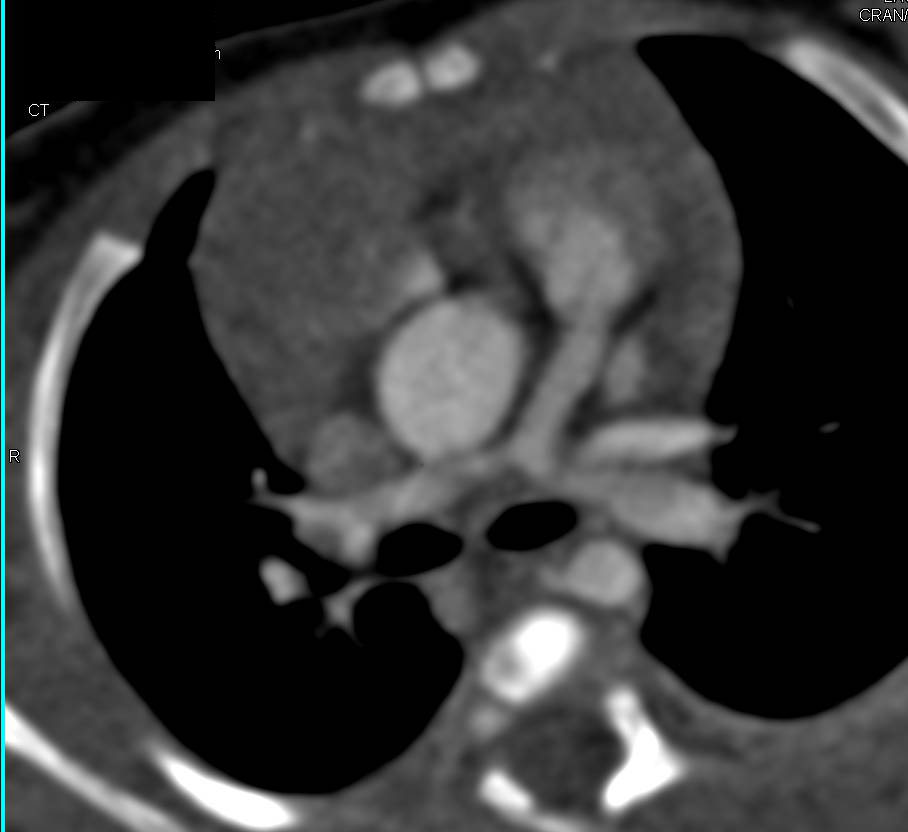 Small Caliber of the Pulmonary Arteries - CTisus CT Scan