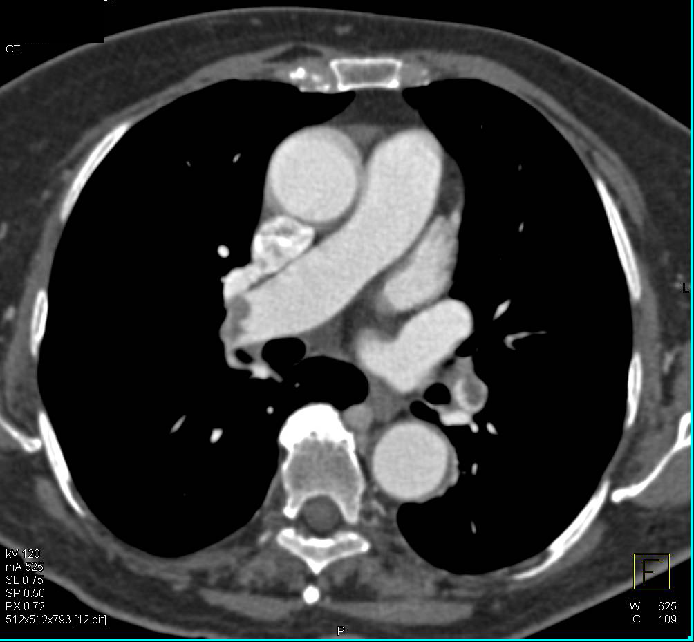 Multiple Pulmonary Emboli in a Patient with Metastatic Pancreatic Cancer - CTisus CT Scan