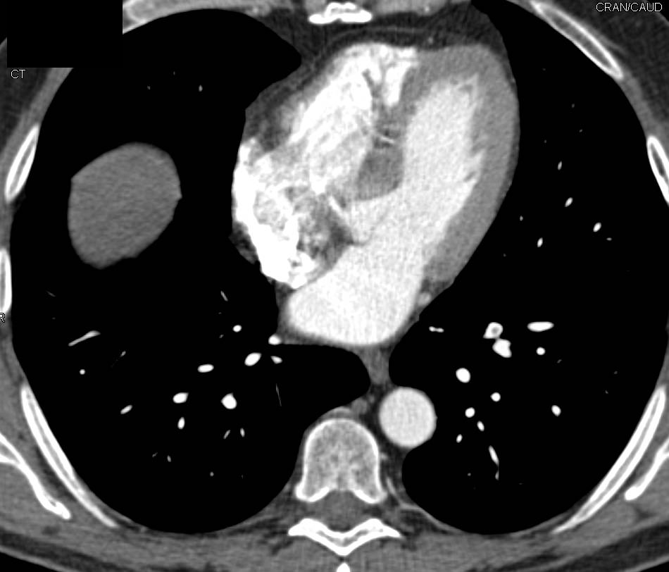 Pulmonary Embolism (PE) in Left Lobe Pulmonary Arteries - CTisus CT Scan