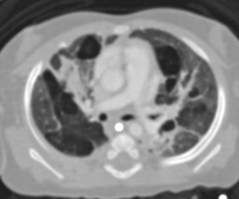 Interstitial Fibrosis with Air Trapping - CTisus CT Scan