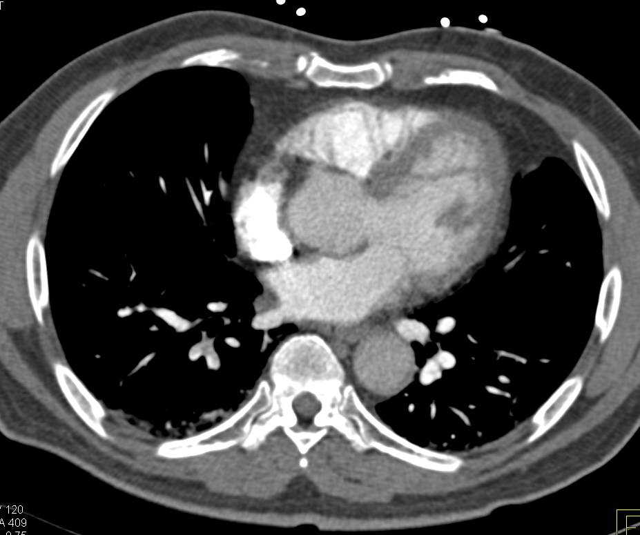 Multiple Pulmonary Emboli (PEs) in the Right Lower Lobe Pulmonary Arteries - CTisus CT Scan