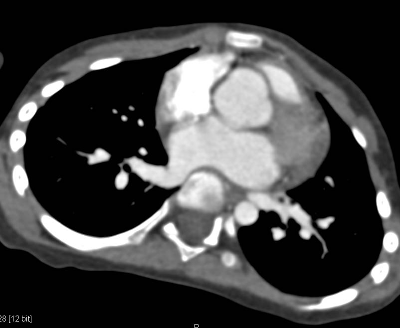 Dilated Aortic Root in Loeys-Dietz Syndrome - CTisus CT Scan