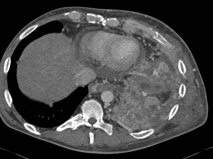 Muliitple Pleural Implants left Chest - CTisus CT Scan