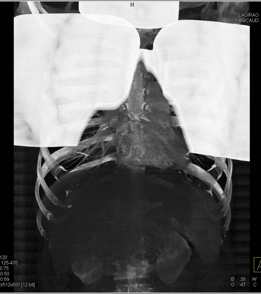 Breast Shields Used for Dose Reduction on Cardiac CT - CTisus CT Scan