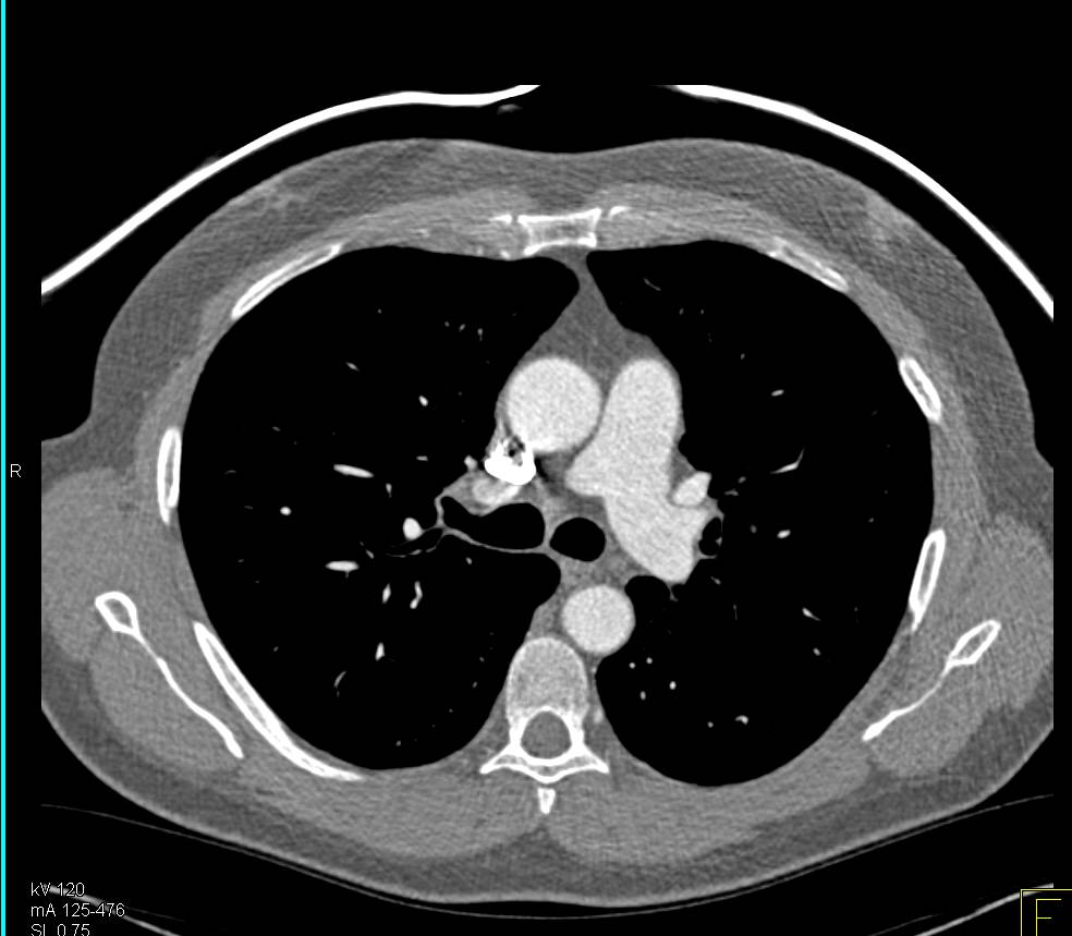 Breast Shields Used for Dose Reduction on Cardiac CT - Chest Case ...