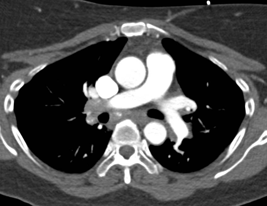 Triple Rule Out Study with Great Enhancement of All Chambers and Vessels - CTisus CT Scan