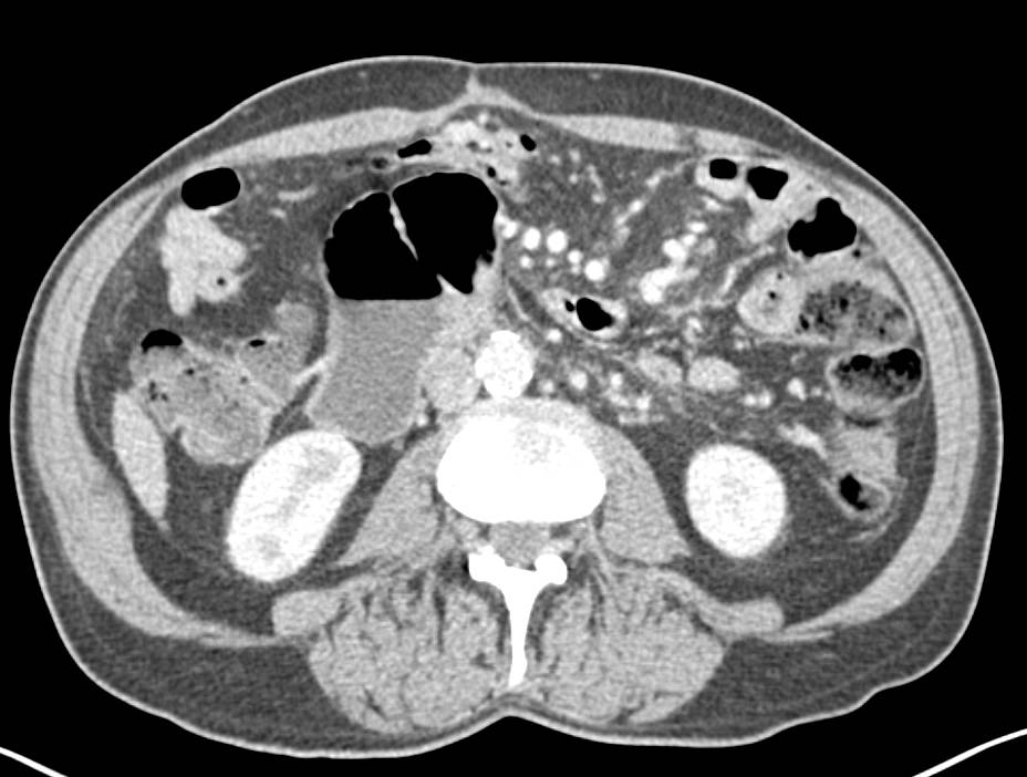 Septic Emboli in a Cancer Patient - Chest Case Studies - CTisus CT Scanning