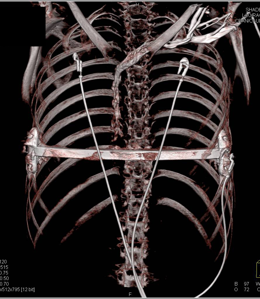 Rod for Pectus Deformity Repair - CTisus CT Scan