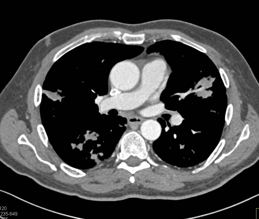 Flame Shaped Infiltrate in Wegener's Granulomatosis - Chest Case