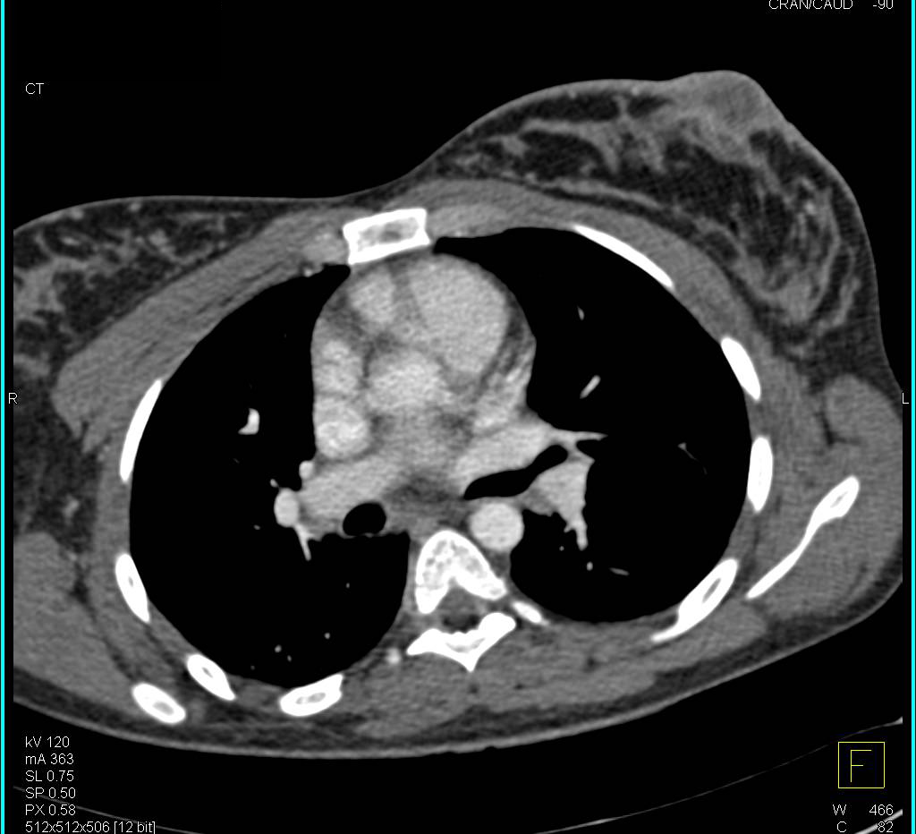 Left Breast Abscess - CTisus CT Scan