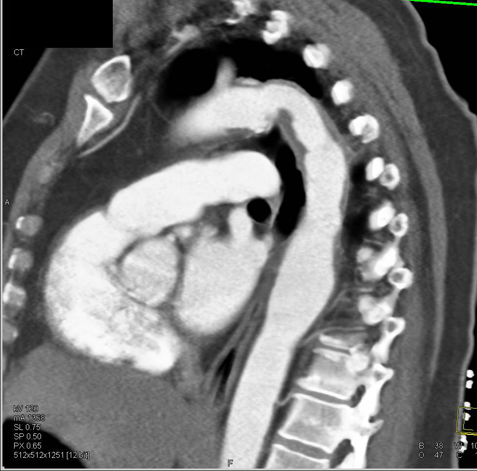 Focal Aneurysm Descending Thoracic Aorta - CTisus CT Scan