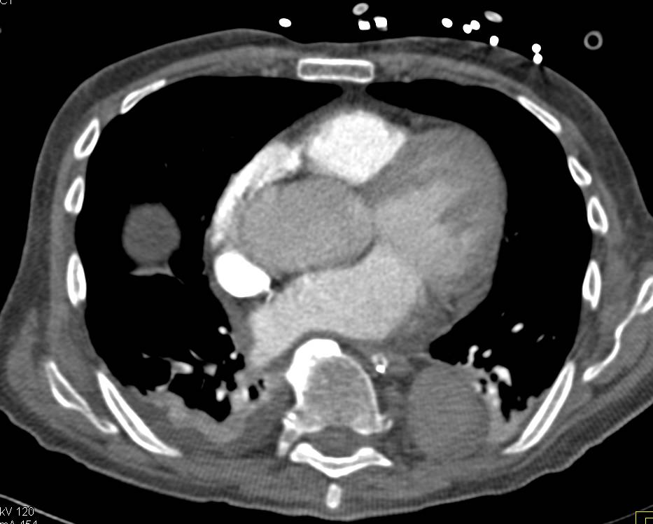 Pulmonary Embolism to Right Lower Lobe Pulmonary Arteries - CTisus CT Scan