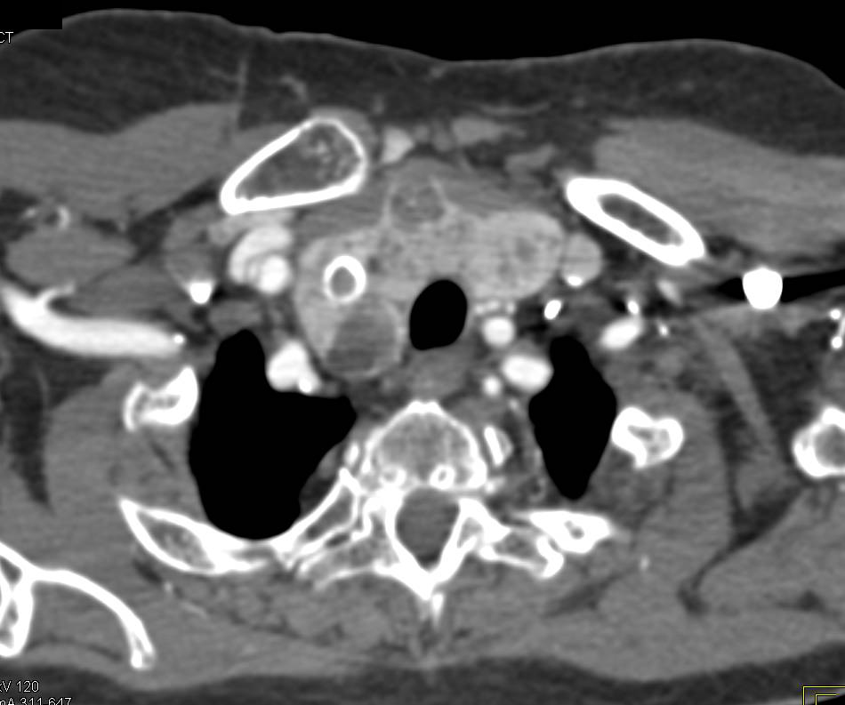 Thyroid Goiter and Gallstones - CTisus CT Scan