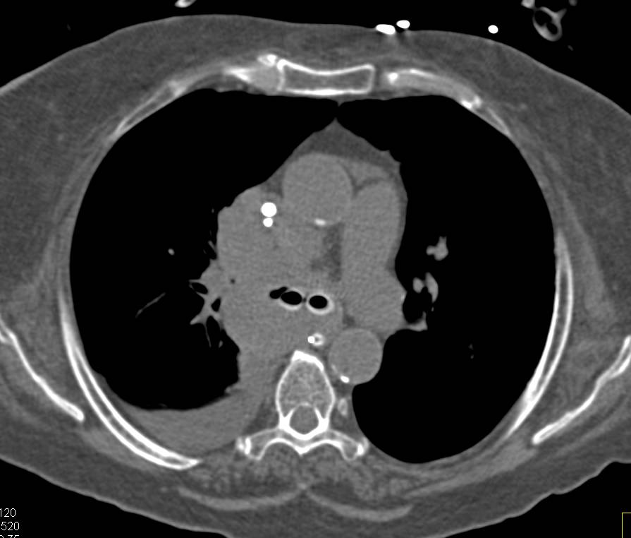 Non-Small Cell Lung Cancer (NSCLC) with Stents in Trachea and Major Bronchi - CTisus CT Scan