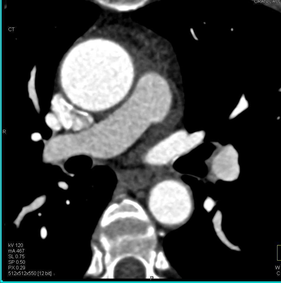 Dilated Aortic Root - CTisus CT Scan