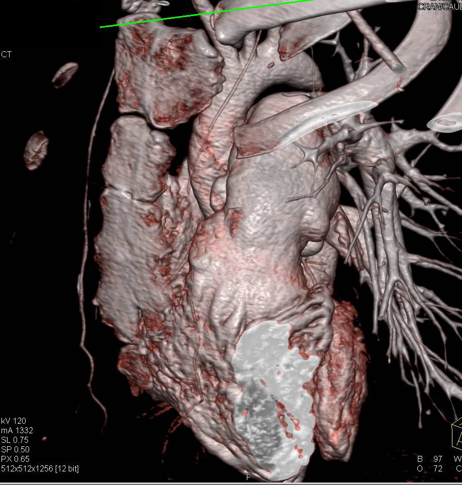 enlarged-main-pulmonary-artery-chest-case-studies-ctisus-ct-scanning