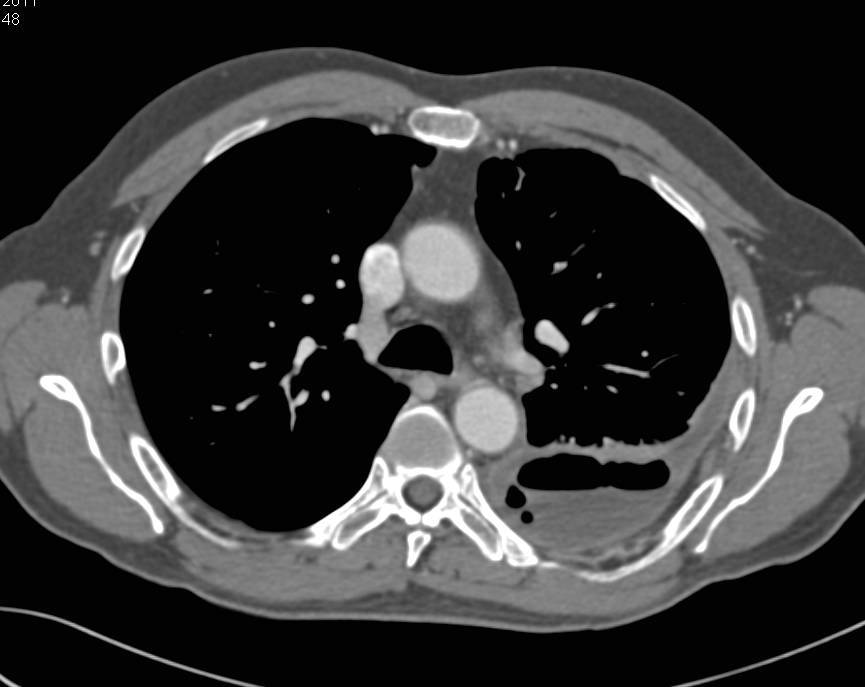 Empyema Develops After Distal Pancreatectomy - CTisus CT Scan