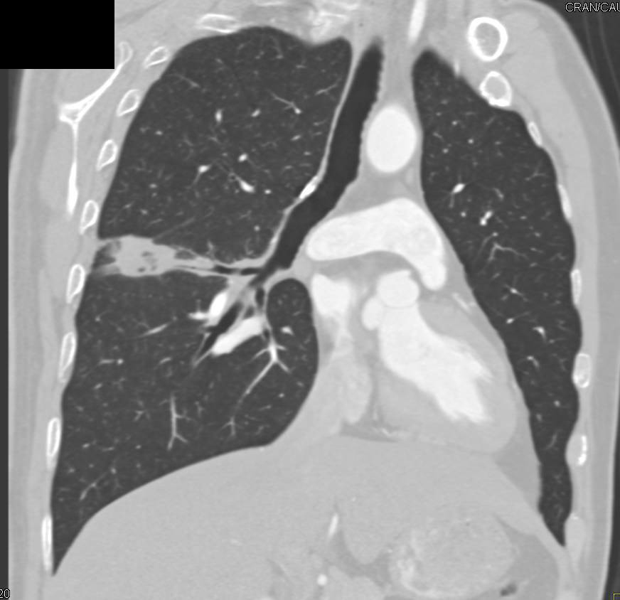 BAC-Bronchioalveolar Cell Carcinoma - CTisus CT Scan