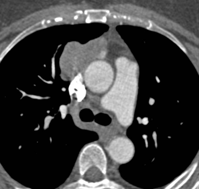 Invasive Thymoma - CTisus CT Scan