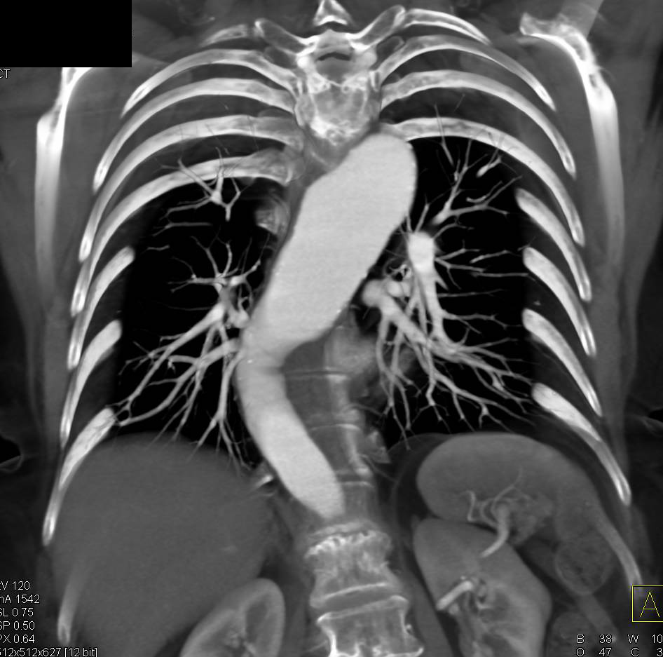 Aneurysm of the Descending Thoracic Aorta - CTisus CT Scan