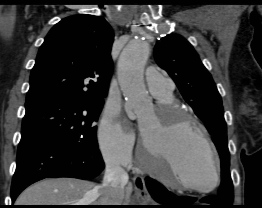 Endovascular Stent in the Thoracic Aorta - CTisus CT Scan