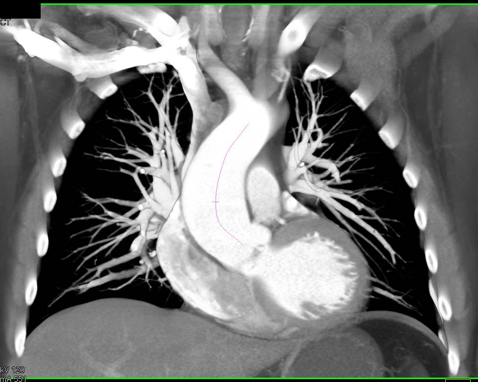 dilated aortic arch