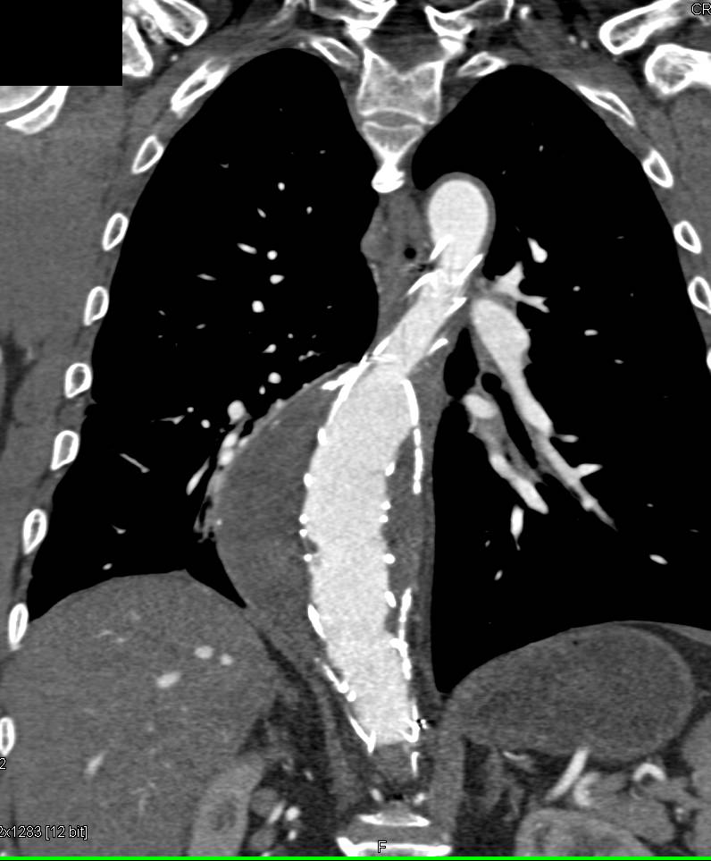 Endovascular Stent Repair of Descending Thoracic Aorta - CTisus CT Scan