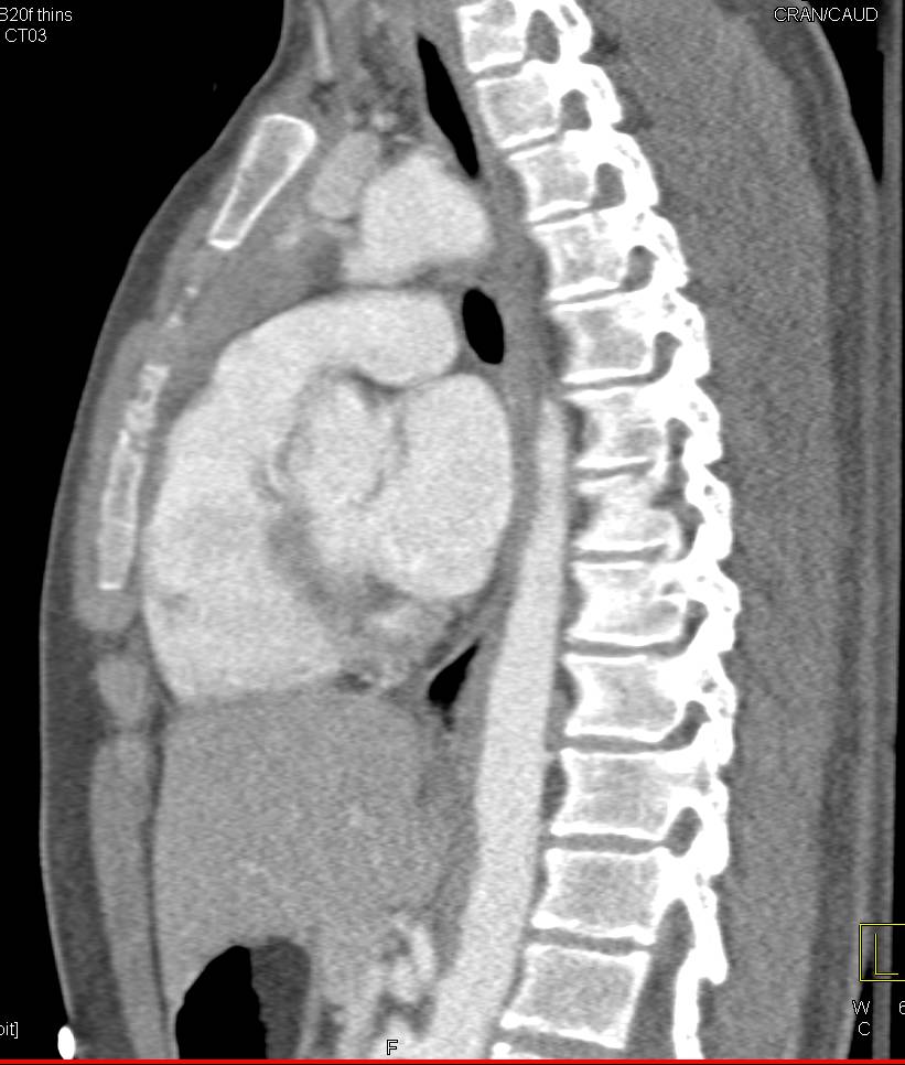 Sequestration Left Lower Lobe with Nice Vascular Display - CTisus CT Scan