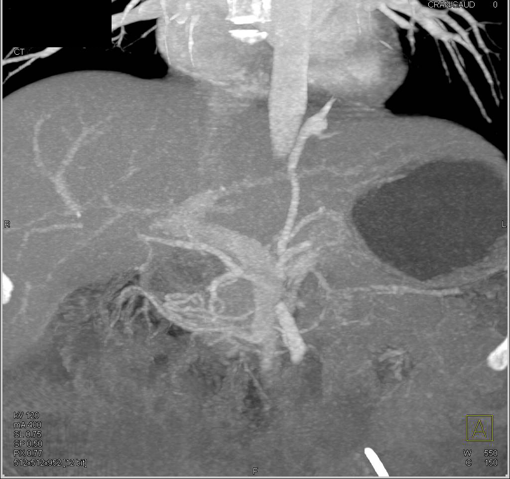 Extralobar Sequestration in Left Lower Lung - CTisus CT Scan