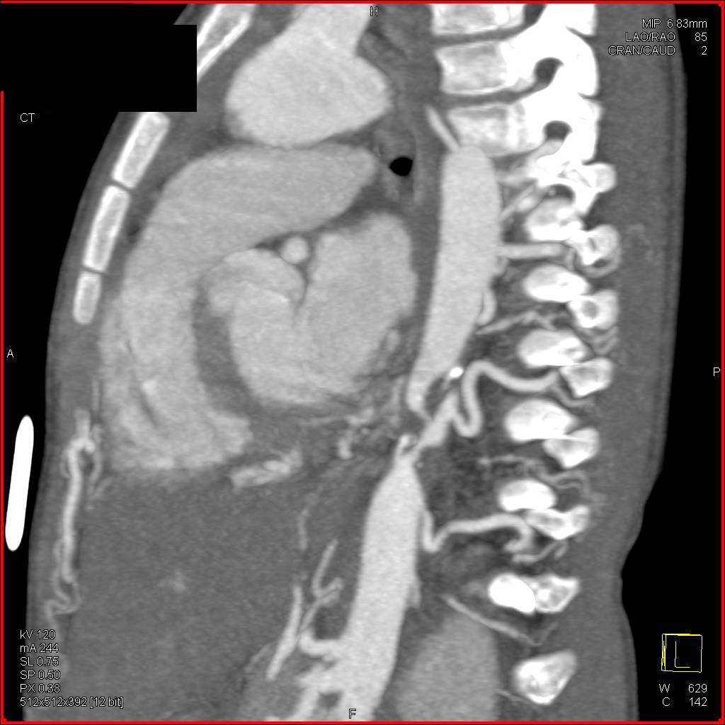 Unusual Case of Stenosis of Mid-Descending Thoracic Aorta with Collaterals - CTisus CT Scan