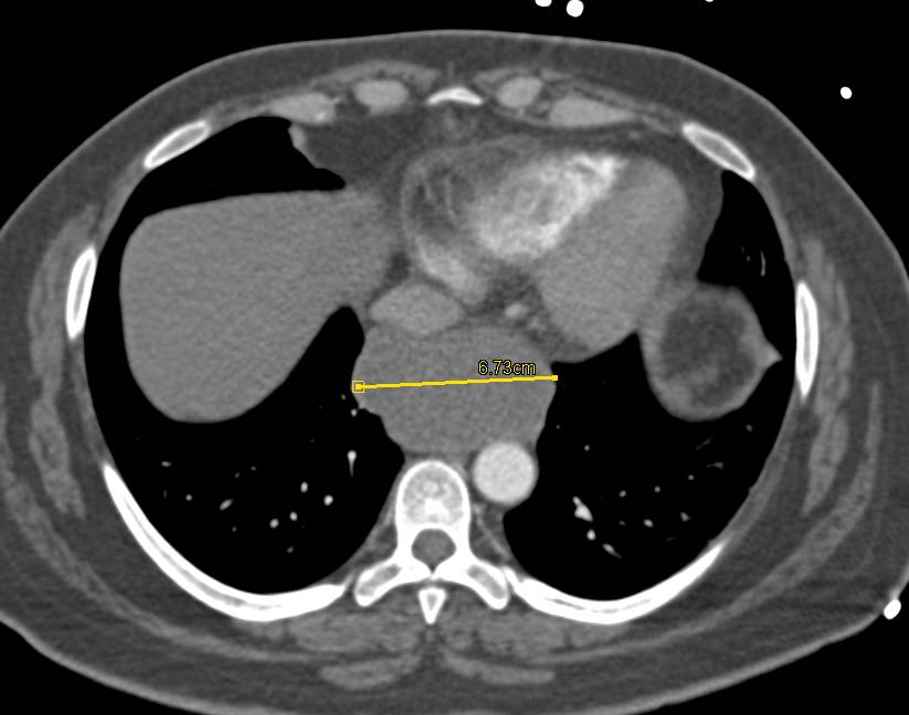 Duplication Cyst Simulating a Mediastinal Mass - CTisus CT Scan