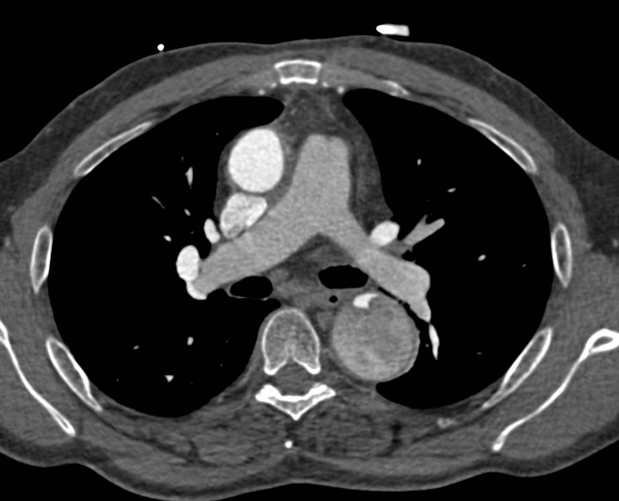 Aortic Dissection with Compression of the True Lumen by the False Lumen - CTisus CT Scan