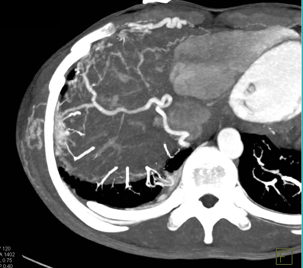 Arteriovenous Malformation (AVM) Involves the Right Chest Wall - CTisus CT Scan