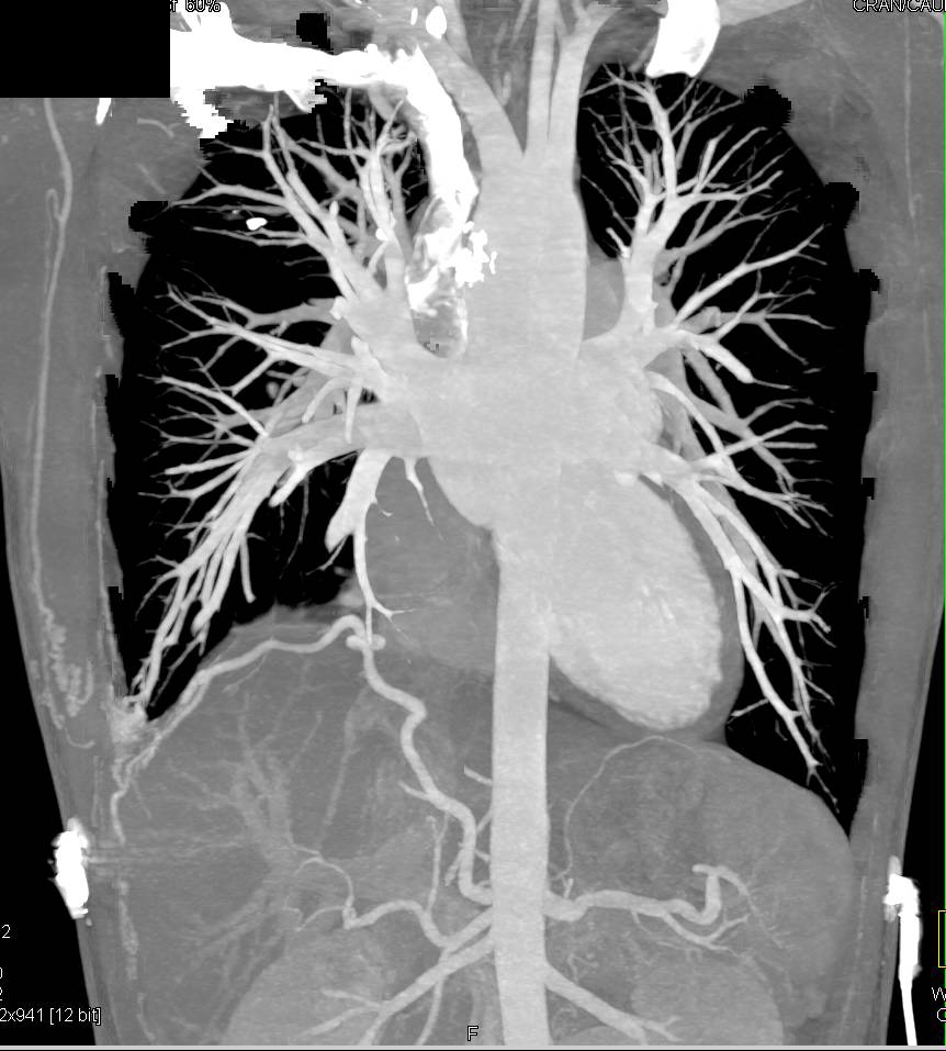 Vascular Malformation Right Lung Extend through the Chest Wall - CTisus CT Scan