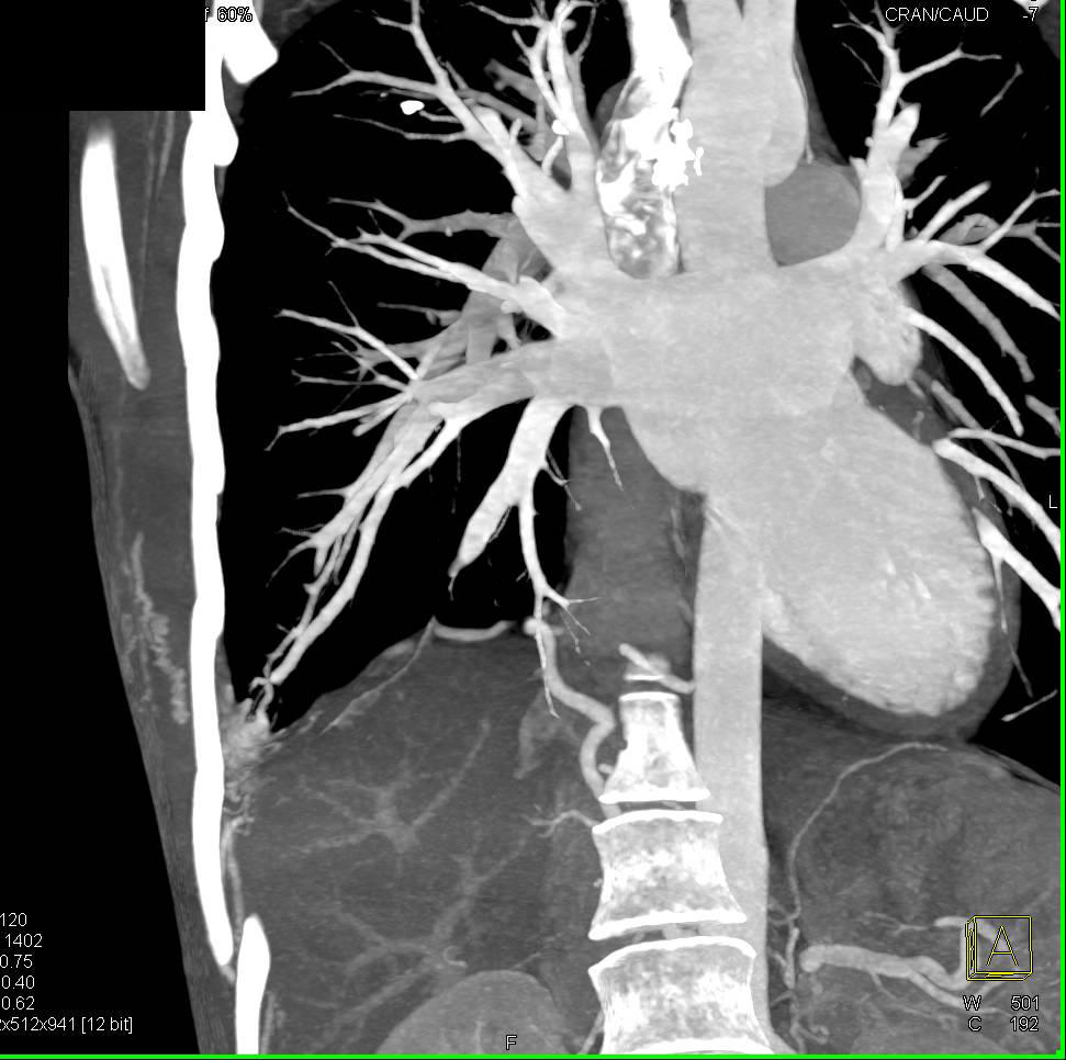 Vascular Malformation in the Chest Wall - CTisus CT Scan