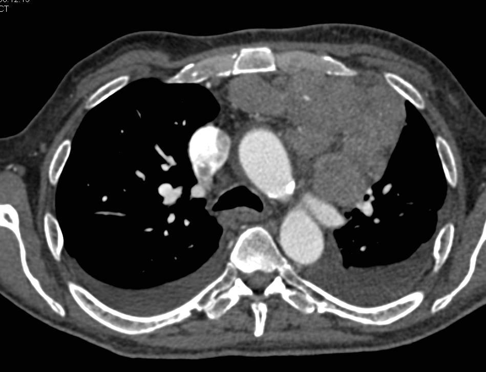 Mediastinal Adenopathy due to Metastatic Renal Cell Carcinoma - CTisus CT Scan