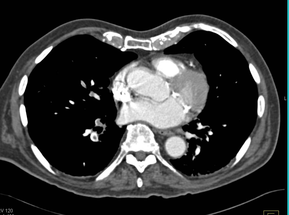 Incidental Pulmonary Embolism in an Oncology Patient - CTisus CT Scan