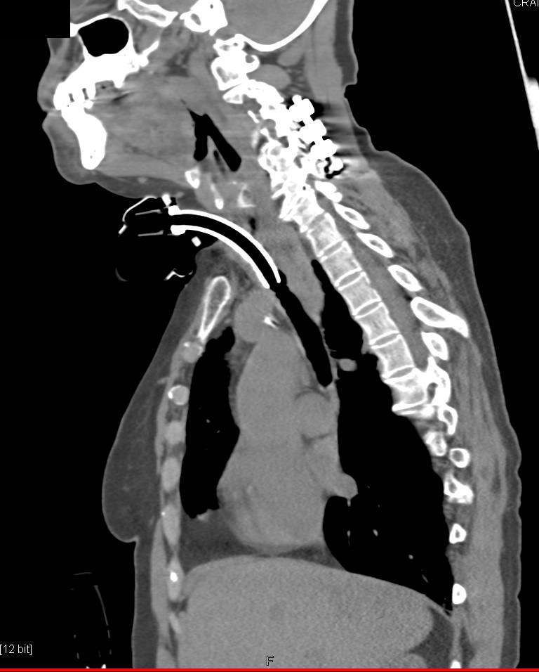 Tracheal Stenosis with Tracheostomy Tube in Place - CTisus CT Scan