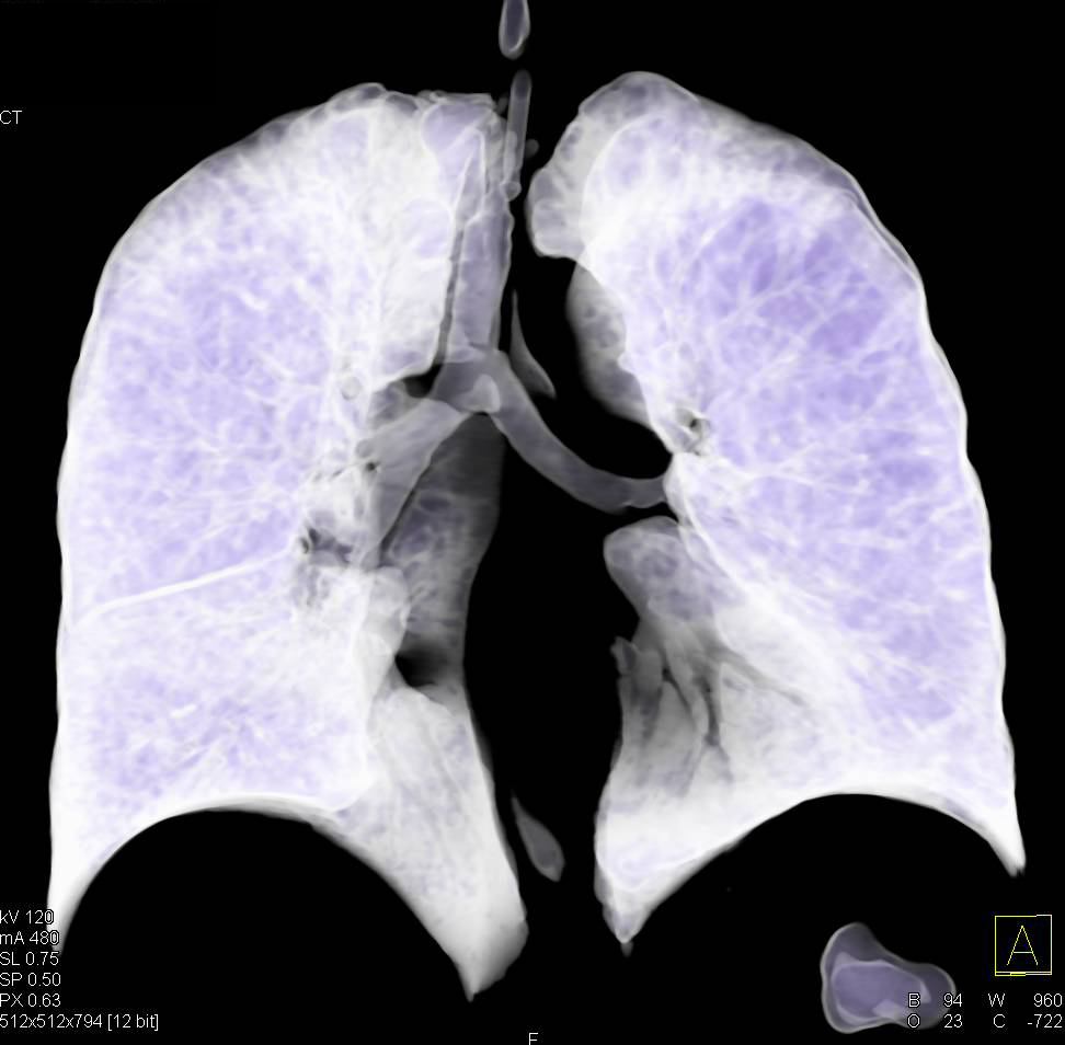 Tracheostomy Tube with 3D Airway - CTisus CT Scan