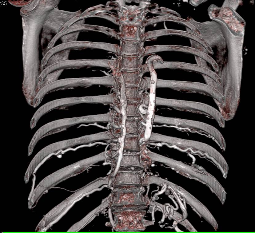 Superior Vena Cava (SVC) Occlusion with Extensive Collaterals Including in Chest Wall - CTisus CT Scan