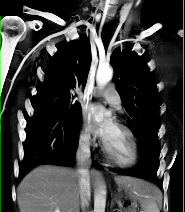 Cavitary Infection Upper Part of Right Upper Lobe - CTisus CT Scan