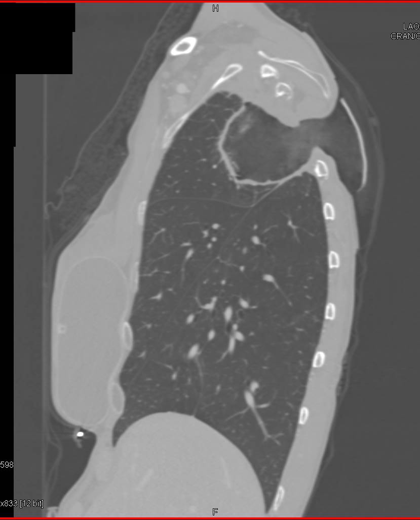 Infection Right Upper Lobe Erodes Through Chest Wall Well Seen in 3D - CTisus CT Scan