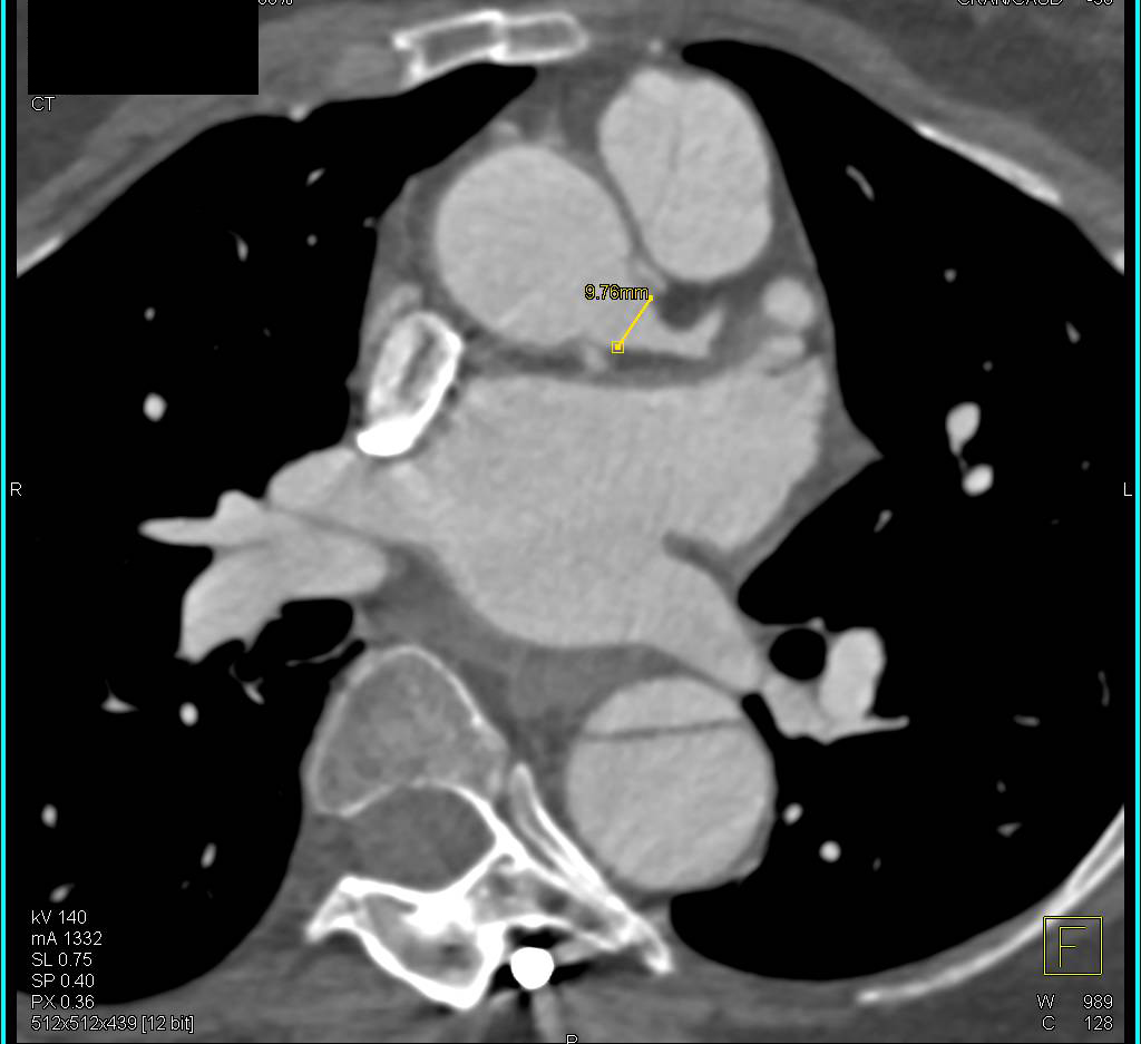 Prior Root Repair in Marfan's Patient with Type B Dissection Now Present - CTisus CT Scan