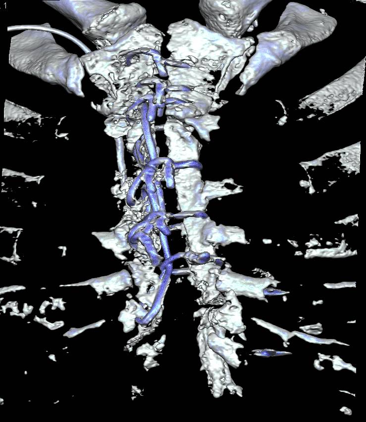 Post Medial Sternotomy without Fusion - CTisus CT Scan