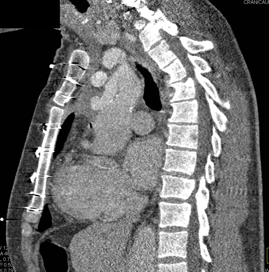 Aortic Root Repair with Dissection - CTisus CT Scan