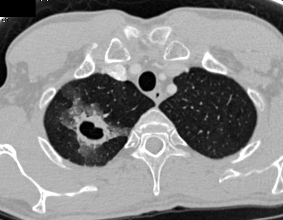 Cavitary Lesion RUL due to Fungal Infection - CTisus CT Scan