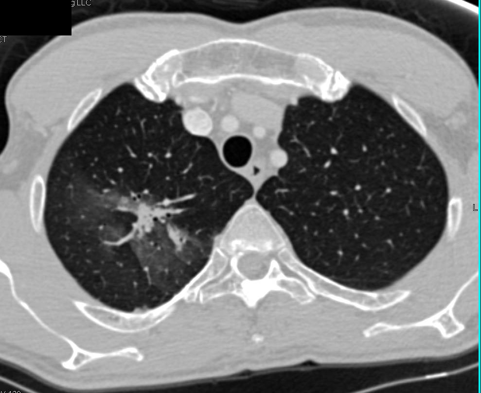 Cavitary Lesion due to Probable Mycobacterium avium/intracellulare (MAI) Infection - CTisus CT Scan