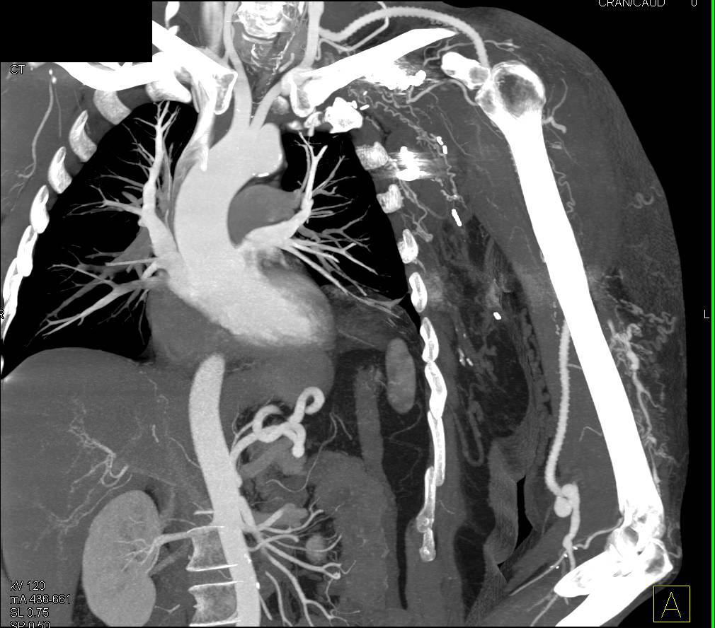 Left Subclavian to Brachial Artery Graft in Patient with Embolization of Left Chest Wall Arteriovenous Malformation (AVM) - CTisus CT Scan