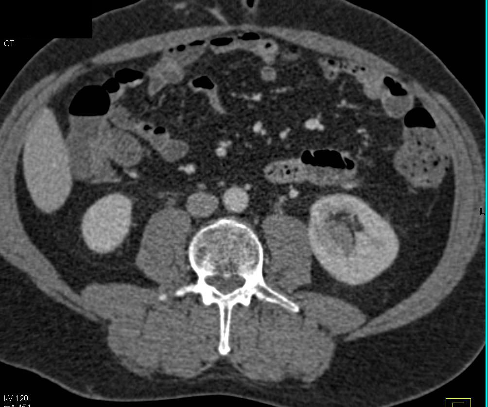 Subtle Acute Pyelonephritis Left Kidney - CTisus CT Scan