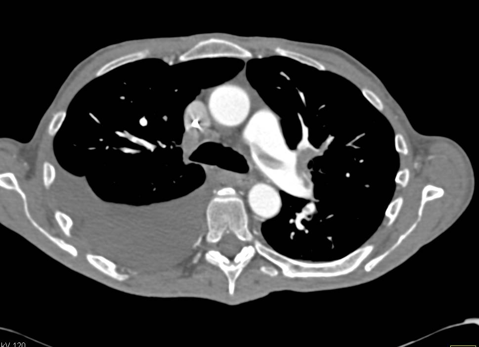 Pulmonary Embolism and Infarction - CTisus CT Scan